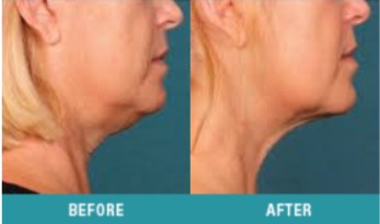 kybella-1