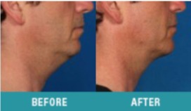 kybella-2