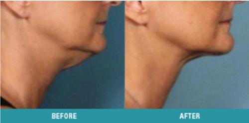 kybella-3