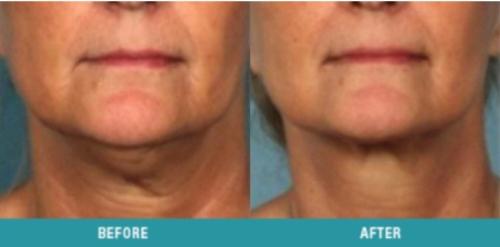 kybella-4
